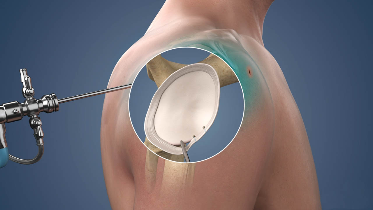 arthroscopy image