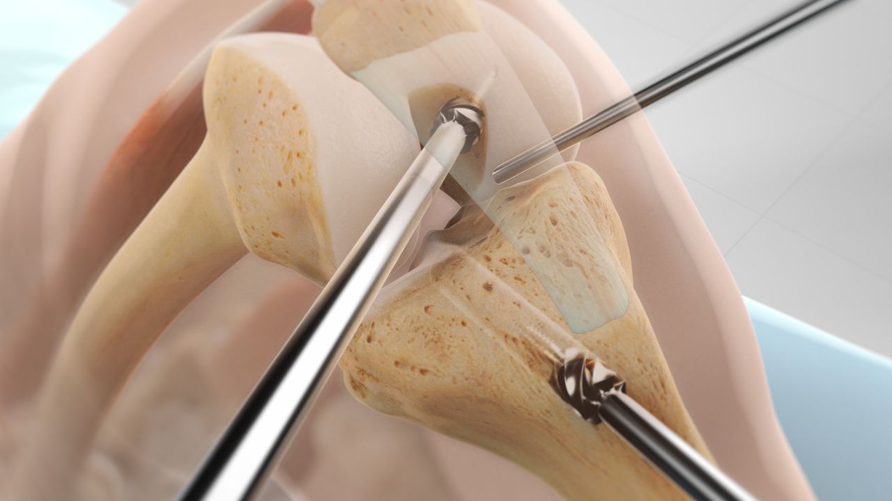 arthroscopy image