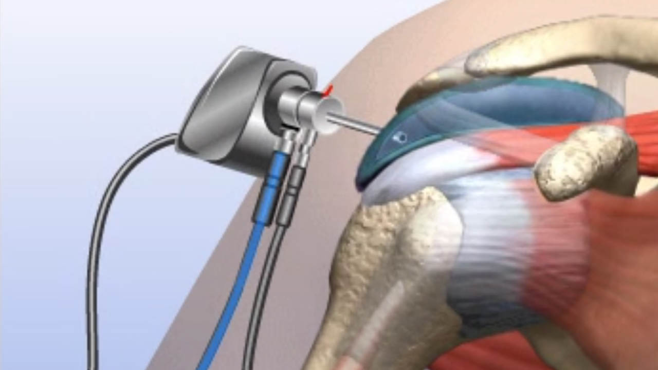 arthroscopy image