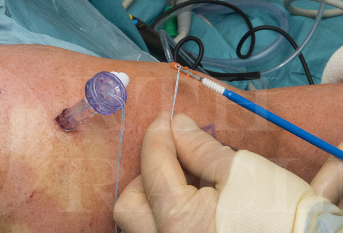 arthroscopy image