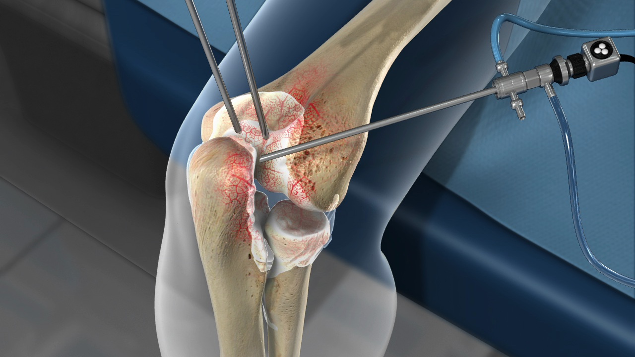 arthroscopy image