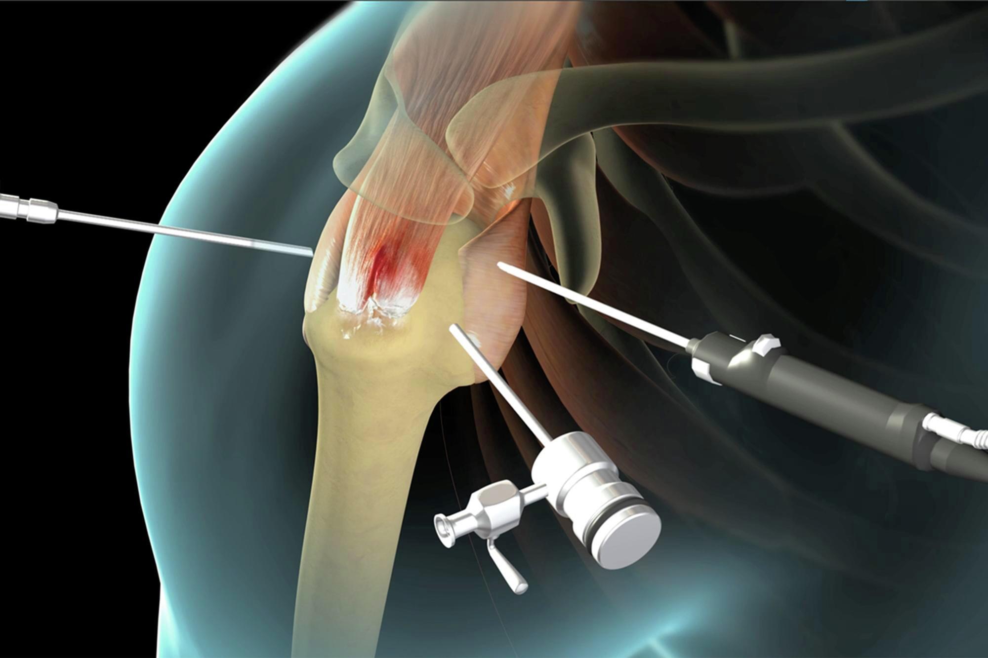 arthroscopy image