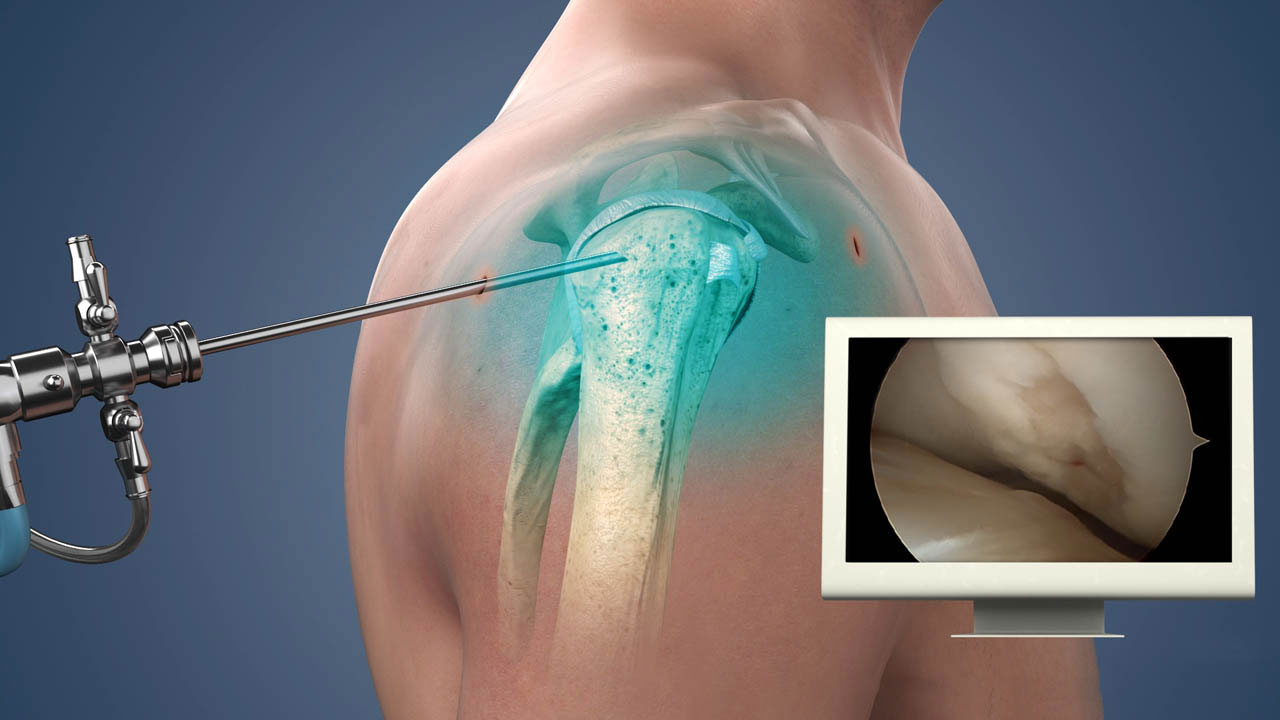 arthroscopy image