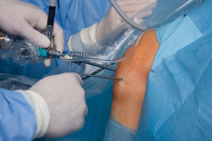 arthroscopy image